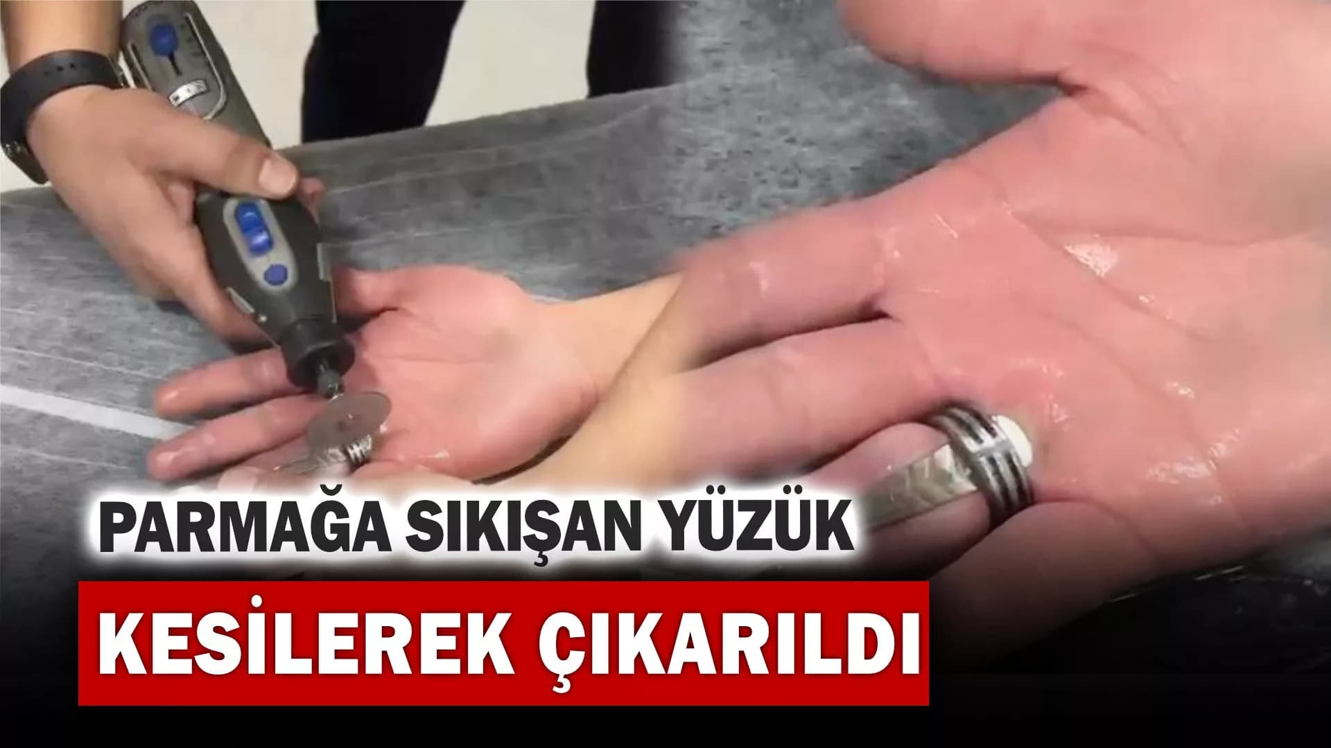 Parmağa sıkışan yüzük kesilerek çıkarıldı