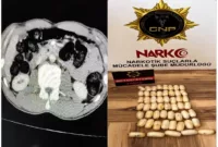 Yabancı uyruklu şahsın midesinden 53 paket uyuşturucu çıktı