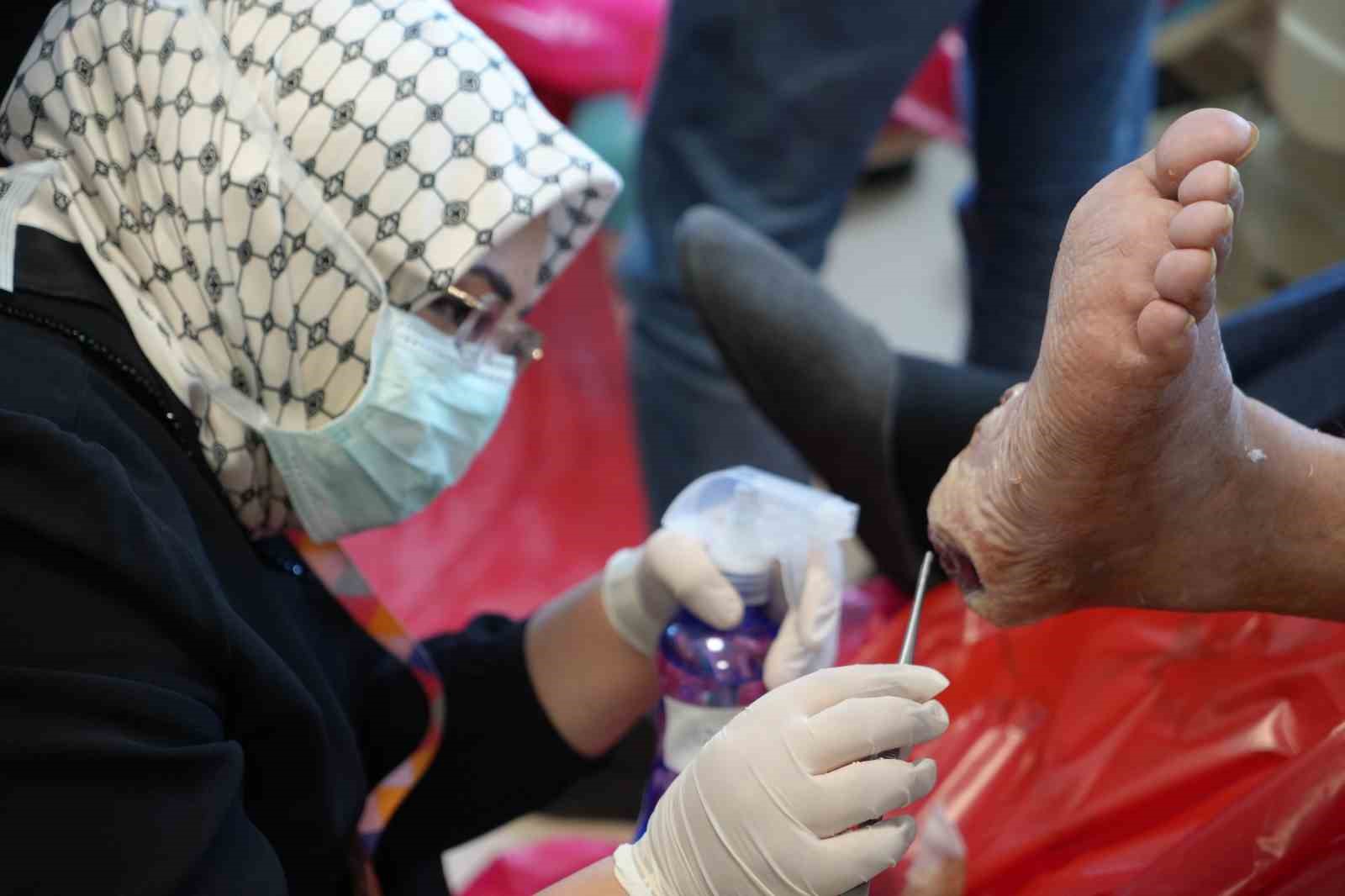 sinek larvalari ile yara tedavisi curumus dokulari yiyorlar bolge kesilmekten kurtuluyor