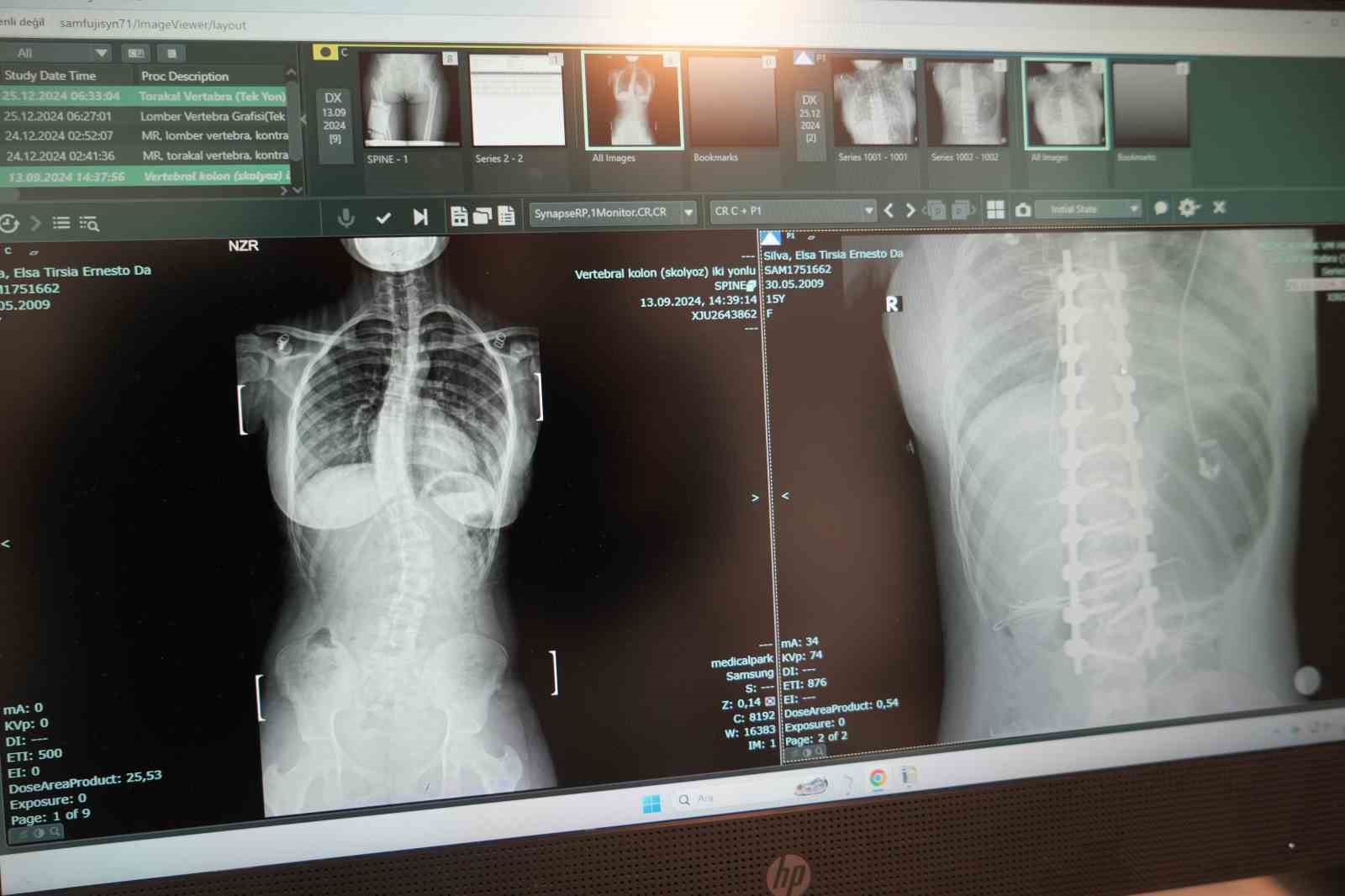 afrikali elsa omurgasindaki 45 derece egrilikten samsunda kurtuldu NumzGkYO