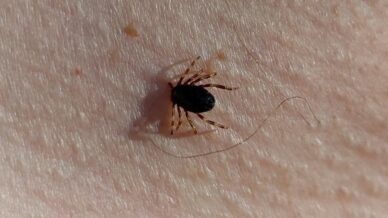 prof dr gurdal yilmaz bu yil 21 kkka vakasi geldi bu hastalardan ikisi hayatini TSLlYYLI