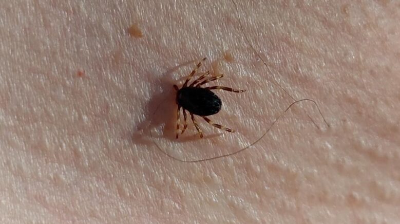 prof dr gurdal yilmaz bu yil 21 kkka vakasi geldi bu hastalardan ikisi hayatini TSLlYYLI