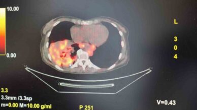 sigarasiz akciger kanseri vakalarinda dikkat ceken artis BnnyeLcP